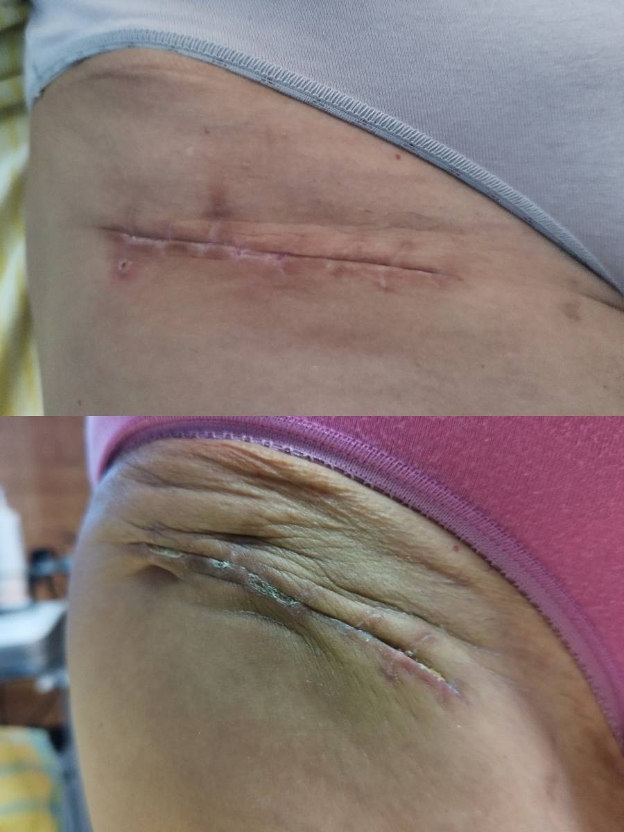 Massage cicatriciel avant/aprés suite à une prothèse de hanche par un abord antérieur à 1 mois de l'intervention sur Bordeaux